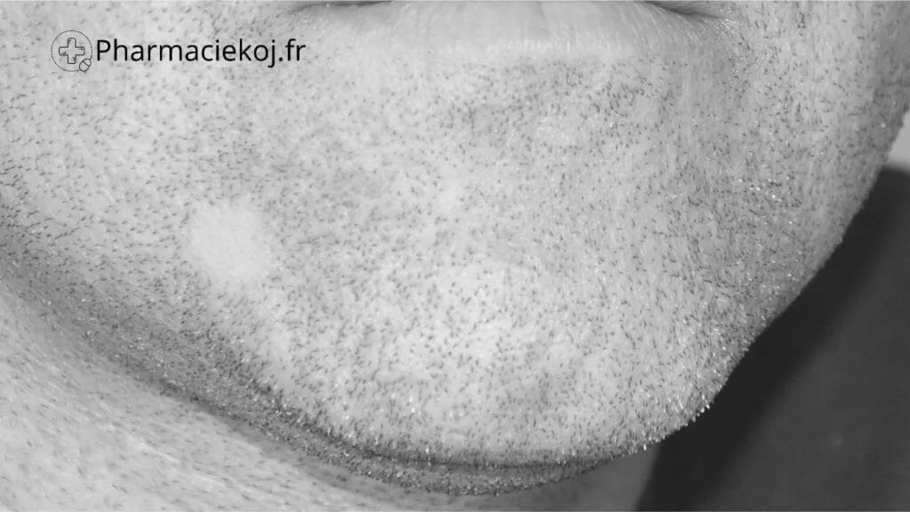 alopécie de la barbe illustration