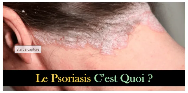 Illustration du psoriasis sur la peau