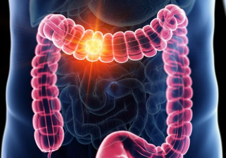 Cancer du côlon illustration médicale
